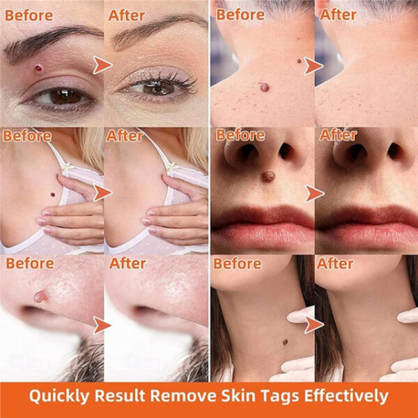 2 IN 1 Auto Micro Skin Tag Remover Device Standard And Micro Skin Tag Removal Kit Adult Mole Wart Remover Original Face Care Beauty Tool 2025 - US $28