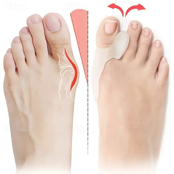 Bunion Cushion Protection (Suitable Night And Home Use And Replace Them Regularly) Toe Corrector Relieving Pressure For Pain Relief 2025 - US $12.49